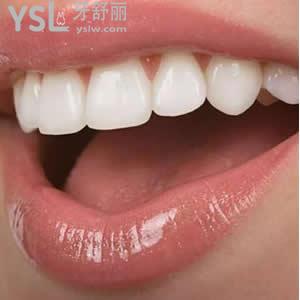 保定合眾口腔價(jià)格表之種植牙一顆多少錢？