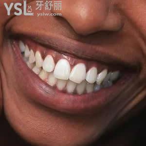 深圳富華醫(yī)院口腔科之金屬自鎖托槽矯正價格錢多少錢？貴嗎？