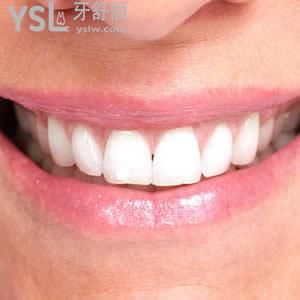 深圳富華醫(yī)院口腔科之時代天使隱形矯正價格貴嗎？