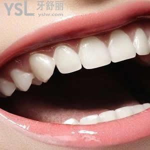 廣州圣貝口腔樹脂補(bǔ)牙價格貴嗎？