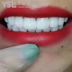 重慶成佳牙博士口腔醫(yī)院價(jià)格之全瓷貼面多少錢？