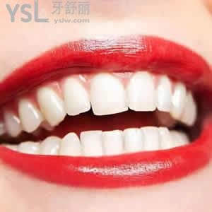 吳江松陵牙博士價格表之瓷貼面（E-MAX4顆套餐）價格優(yōu)惠