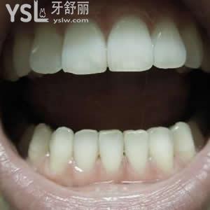 南通牙博士口腔門診部價目表之鑄瓷嵌體活動優(yōu)惠
