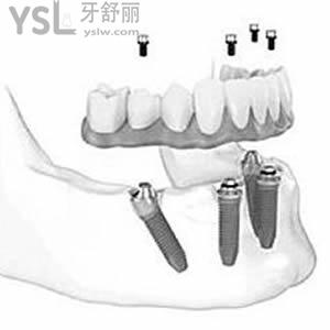 廈門登特口腔收費價格表安排上，其中包含種植牙和矯正的費用