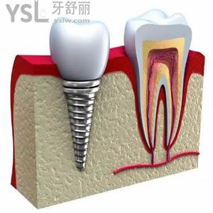 武漢五洲麥芽口腔醫(yī)院韓國奧齒泰種植牙特大優(yōu)惠。