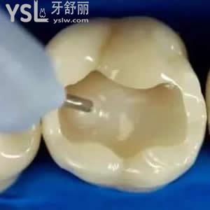 珠海九龍口腔醫(yī)院價(jià)格貴嗎？進(jìn)口3M納米樹(shù)脂補(bǔ)牙價(jià)格優(yōu)惠。