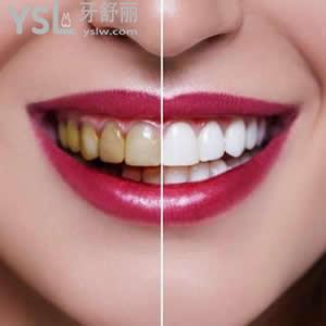 珠海九龍口腔醫(yī)院收費標準，牙齒貼片全瓷貼面優(yōu)惠價格活動。