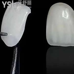 珠海九龍口腔醫(yī)院價目表，牙齒貼片樹脂貼面優(yōu)惠活動