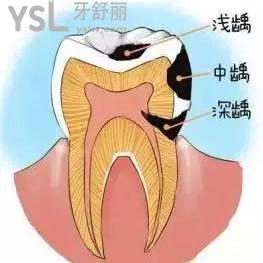 鄭州拜博口腔醫(yī)院價格貴嗎？美國3M納米樹脂補牙活動價可一點都不貴。