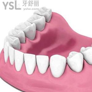 鑲一顆假牙一般需要多少錢？