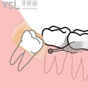 國產(chǎn)氧化鋯全瓷牙冠價格，氧化鋯全瓷牙和二氧化鋯全瓷牙有什么區(qū)別？