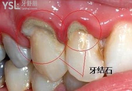 洗牙一次多少錢(qián)？時(shí)間長(zhǎng)嗎？