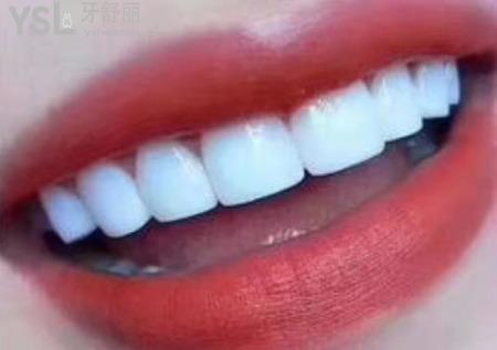 做貼面需要?dú)⒀郎窠?jīng)嗎？