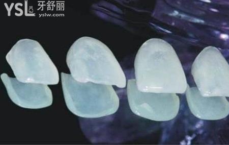 烤瓷牙貼面能使用多久？