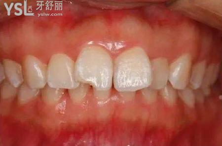 牙周治療怎么治療？