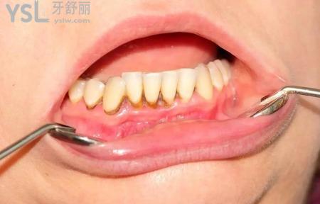 什么樣的牙需要牙周手術(shù)治療。