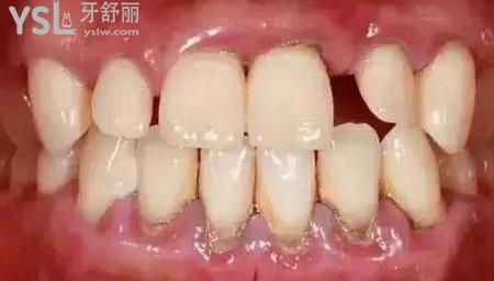 什么叫牙周刮治？
