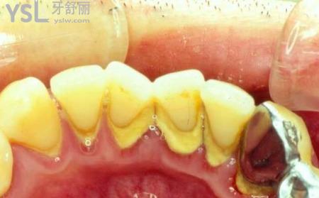 牙周刮治有什么副作用？