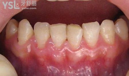 牙周刮治一般是做幾次？