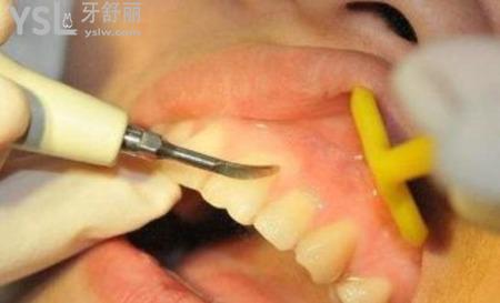 牙齒根周炎是怎么引起的？