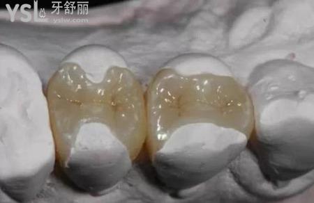 什么是嵌體修復(fù)？
