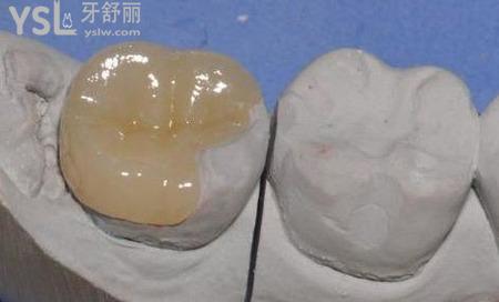 嵌體好還是烤瓷牙好？