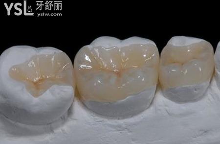 嵌體使用的注意事項(xiàng)有什么？