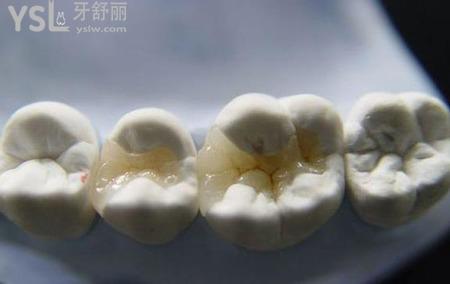 嵌體和全冠哪個(gè)好？