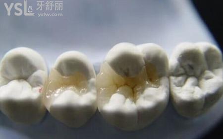 嵌體的優(yōu)缺點(diǎn)是哪些？
