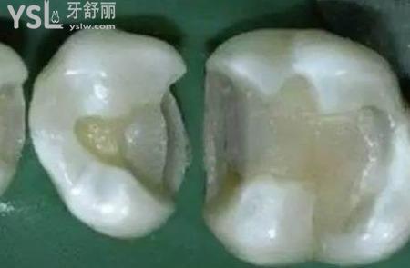 嵌體是怎么制作的？
