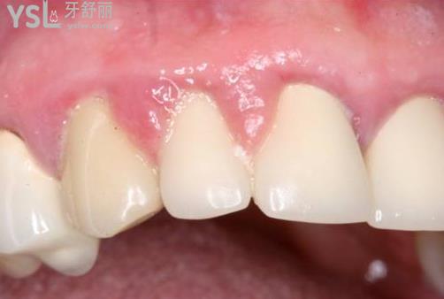 牙齦增生洗牙后就會(huì)好嗎？