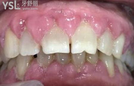 小孩牙齦增生要割掉嗎？