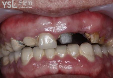 牙齦增生手術(shù)要住院?jiǎn)幔? class=