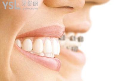 一般牙齒正畸的年齡限制是多少？