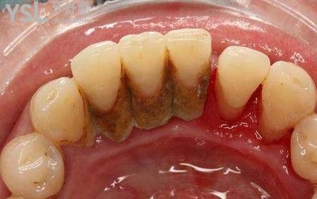 牙周膿腫吃藥有用嗎？