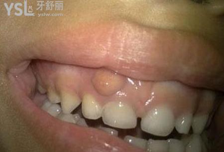 牙上面起個(gè)膿包怎么辦？