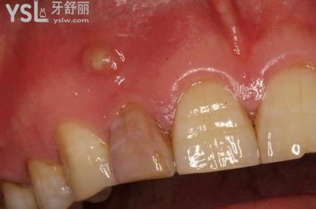 兒童牙齦長膿包怎么處理？