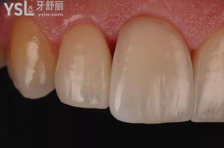 瓷貼面修復(fù)后的注意事項(xiàng)？