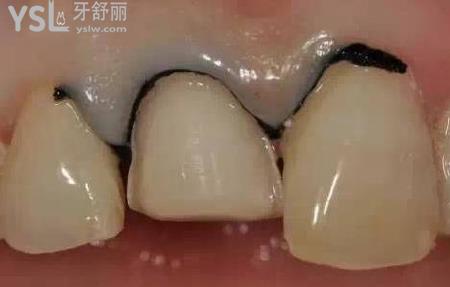 瓷貼面容易掉嗎？