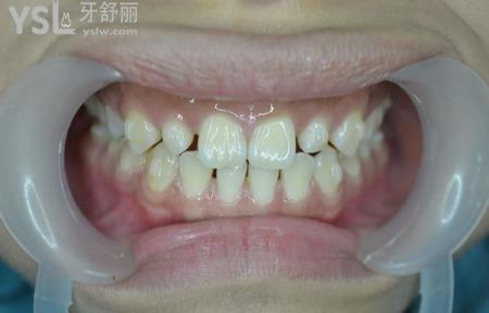 什么癥狀比較適合做瓷貼面？