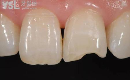 瓷貼面修復(fù)有哪些優(yōu)勢？