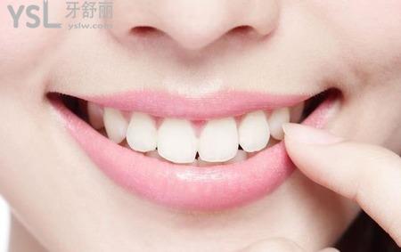 瓷貼面后該怎么自我維護和保養(yǎng)？