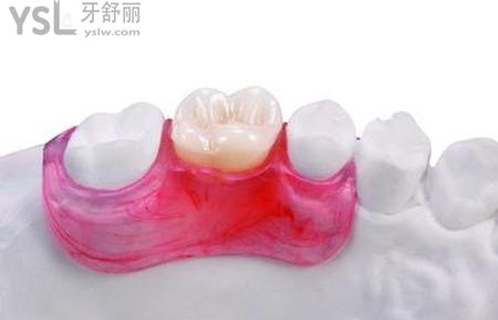 活動義齒幾天能裝？