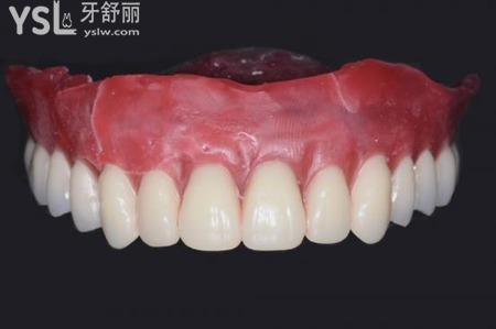 門牙怎么做活動義齒？