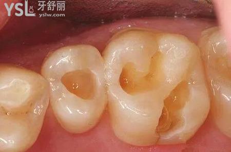 補(bǔ)牙為什么疼？