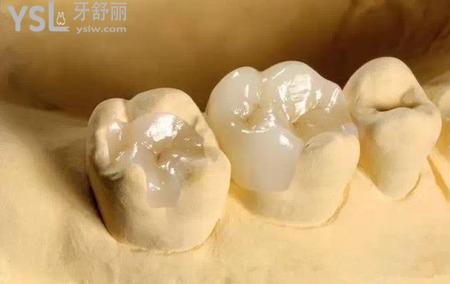 嵌體修復(fù)的優(yōu)勢是什么？