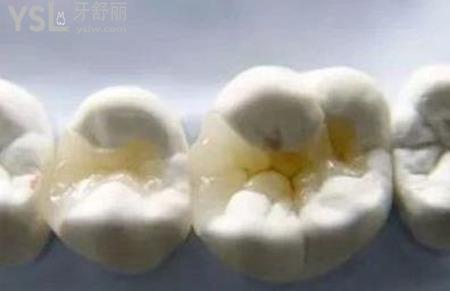 嵌體修復(fù)的禁忌癥是什么？