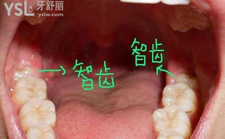 智齒不歪需要拔掉嗎？