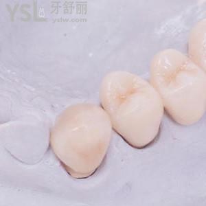 拉瓦全瓷牙一顆價格？