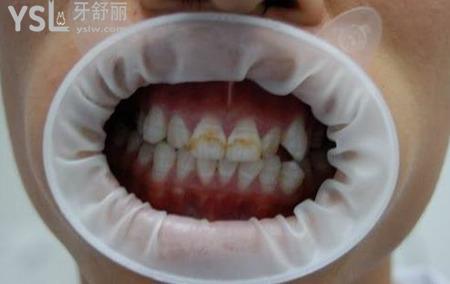 氟斑牙是怎么形成的？